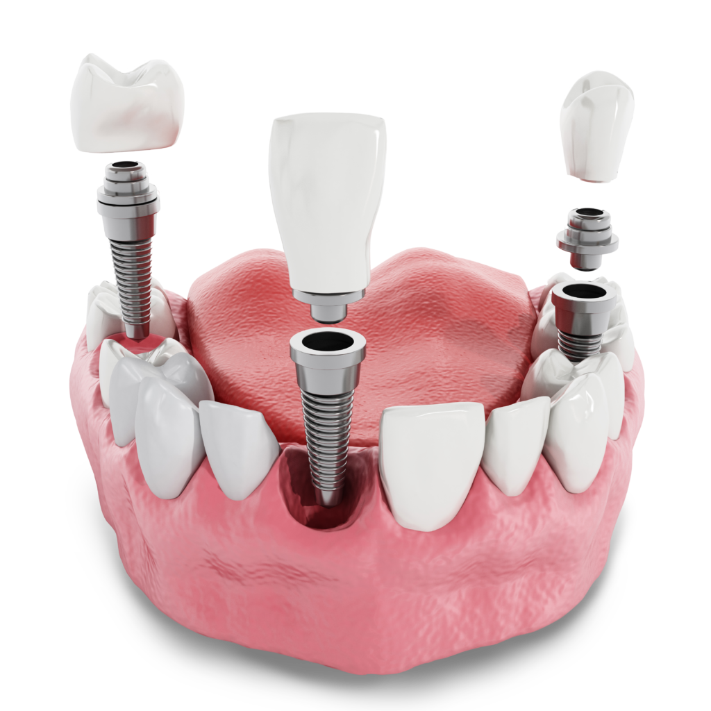 dental implant model MONTCLAIR, NJ