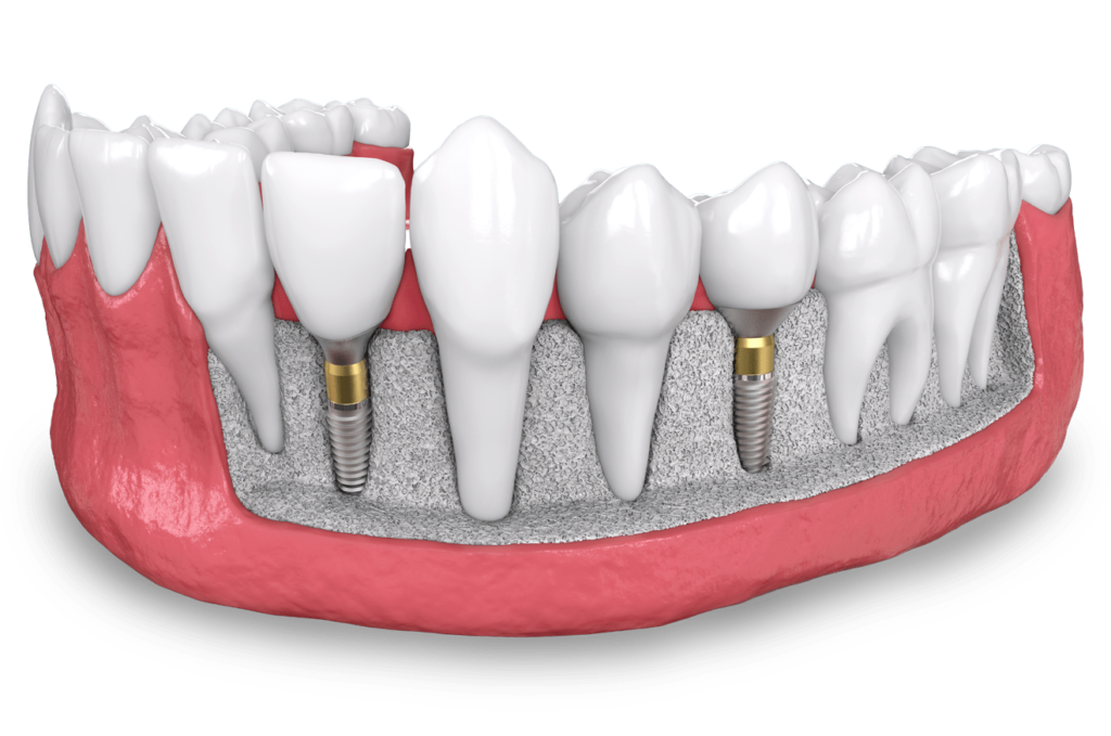 dental implant model MONTCLAIR, NJ