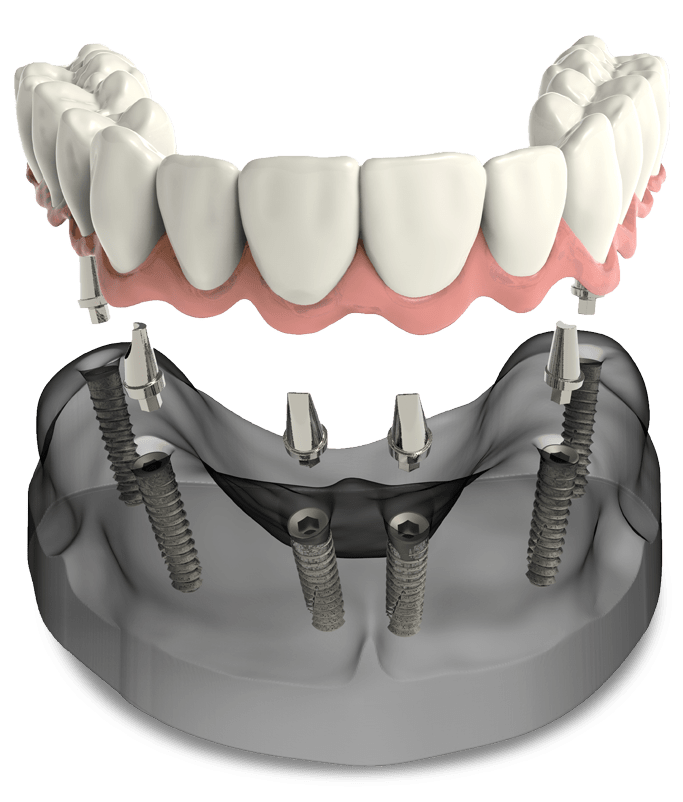 full arch dental implants model MONTCLAIR, NJ