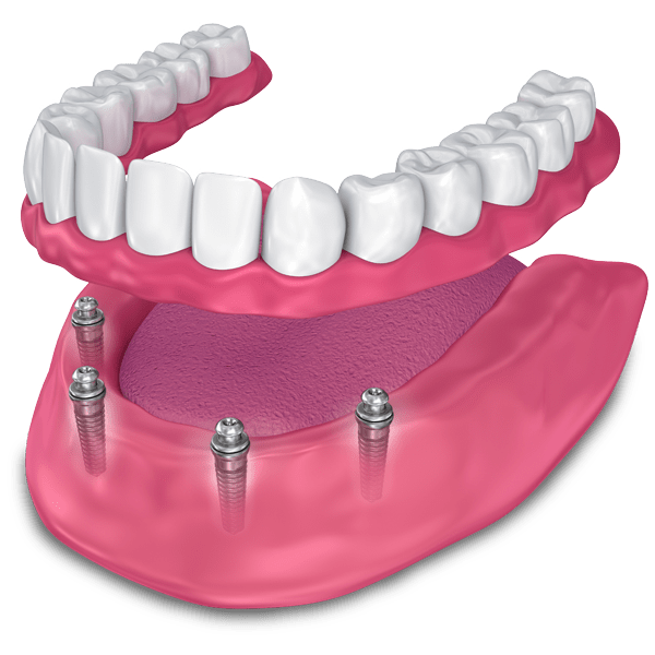 implant supported dentures model MONTCLAIR, NJ