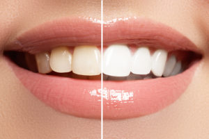 Teeth whitening image for cosmetic dentistry in Montclair