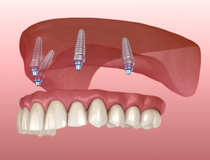 understanding dental implants