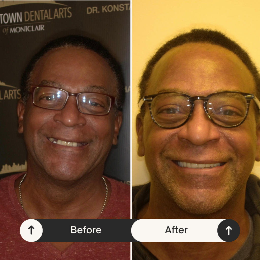 Smile Makeover Before and After
