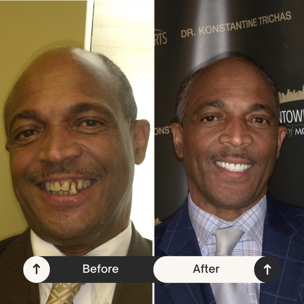 Dental Implants before and After Smile